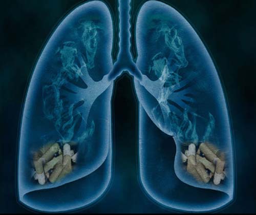 نقشه‌ برداری از یک بیماری مرگبار ریه با تکنیک تصویر برداری سه‌ بعدی